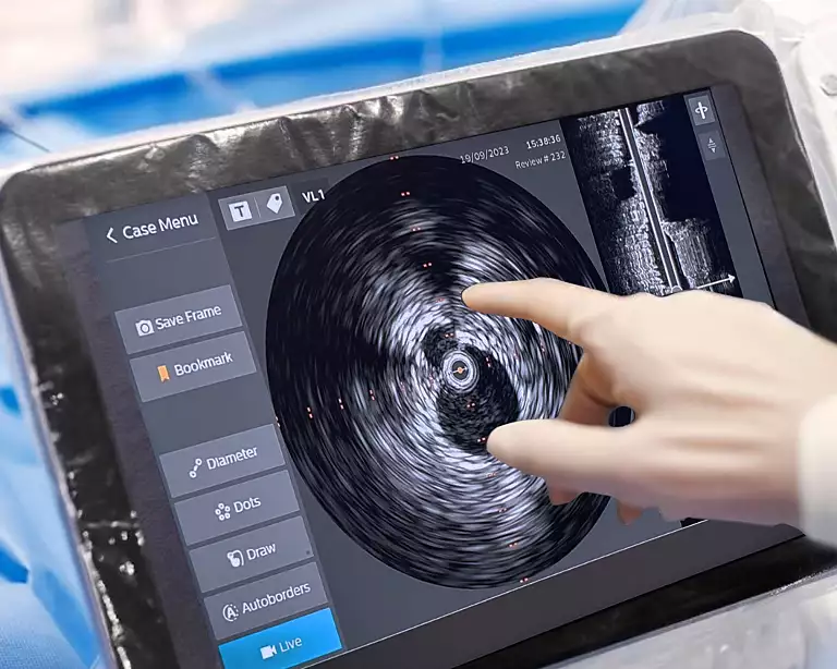 Intravascular Ultrasound (IVUS)